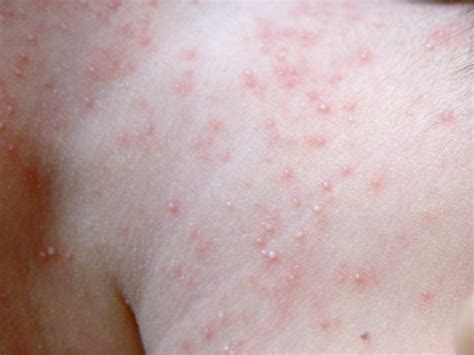 分析慢性荨麻疹有哪些危害-长春华山皮肤病医院