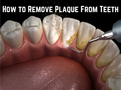 Image result for How to Remove Teeth Video