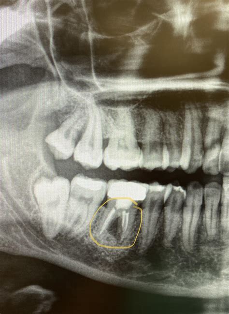 Root Canal Abscess X Ray at Clifford Rains blog