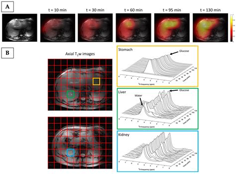 Potential of Metabolic MRI to Address Unmet Clinical Needs in Localised ...