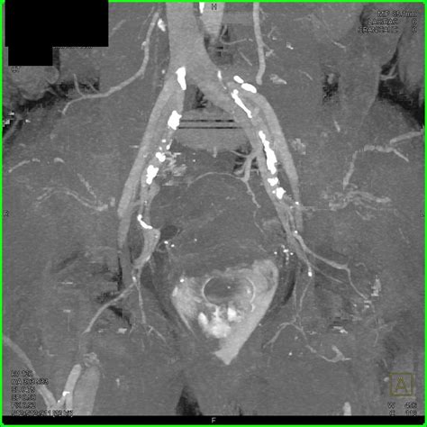 Active Rectal Bleed - Colon Radiology Case Studies - CTisus CT Scanning