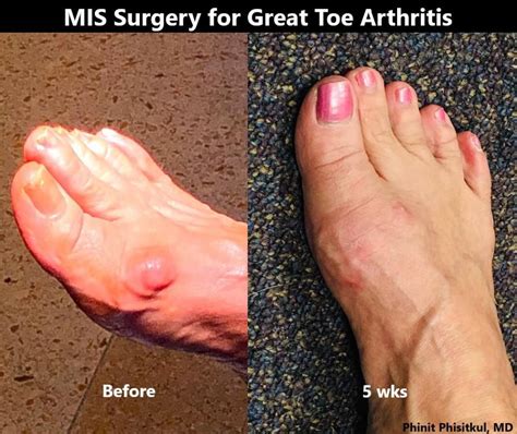 Minimally Invasive Correction of Big Toe Arthritis (Hallux Rigidus ...