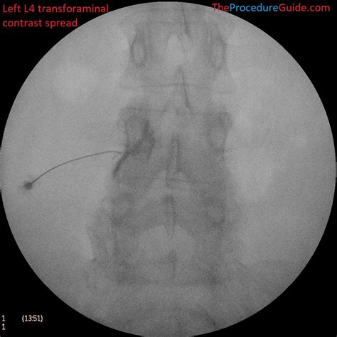 Image result for Fluoroscopy Injection