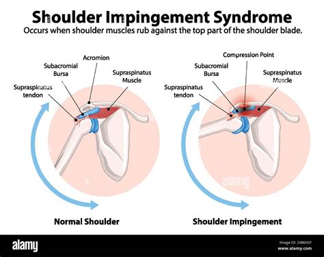 Comparison of normal shoulder and impingement Stock Vector Image & Art - Alamy