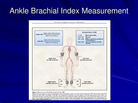 Ankle-Brachial Index Procedures Using Unit IX 的图像结果