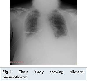 Use of Bag Valve Device Resulting in Pneumothorax