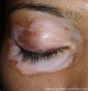 S.P.Derma Center Vitiligo treatment results