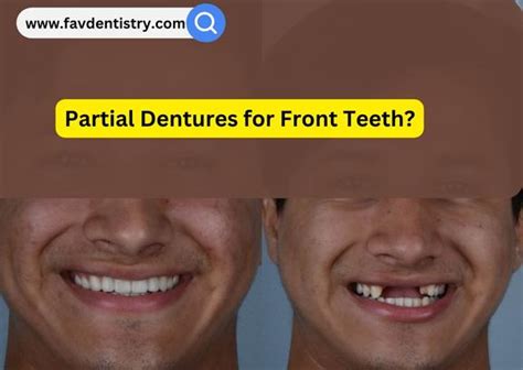 Image result for Front Teeth Partials Options