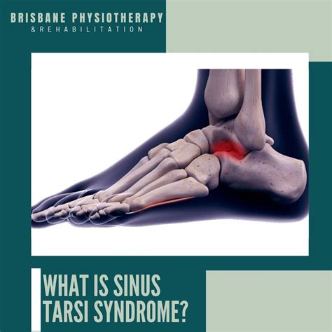 Sinus Tarsi Syndrome