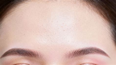 Expert Acne Treatment & Clear Skin Solutions