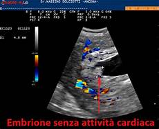 gestazionale senza embrione cause gestazionale senza embrione cause