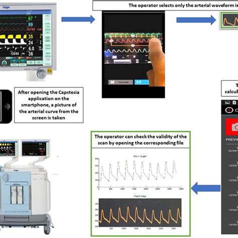 Image result for Pulse Pressure Variation Monitoring