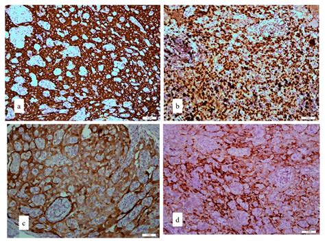 The Scrotal Excision of Paratesticular Mesothelioma of the Tunica ...