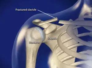 MIPO more advantageous than ORIF in treatment of displaced midshaft ...