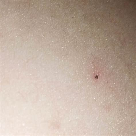 Hi y'all, I lately just discovered this tiny black dot on my skin, at the lower part of my ...