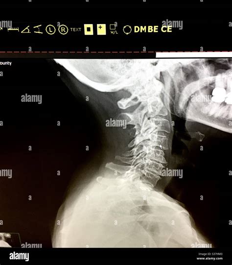 X-ray showing cervical arthritis of the neck Stock Photo - Alamy