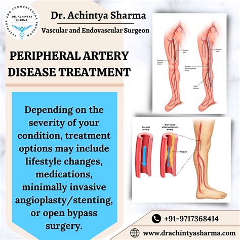Best guide and medications for Peripheral Artery Disease treatment