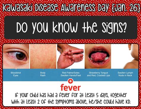 Kawasaki Disease Strawberry Tongue