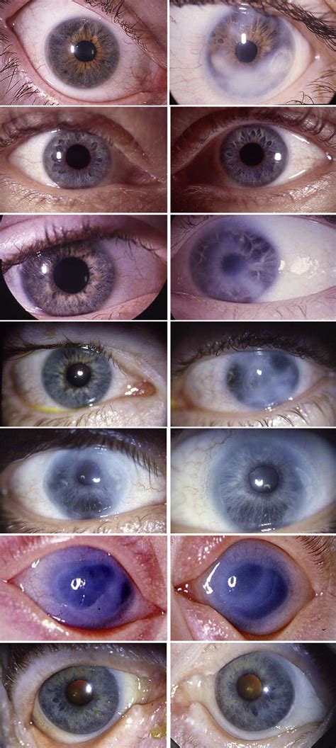 Image result for Iris Recognition Using MATLAB Source Code