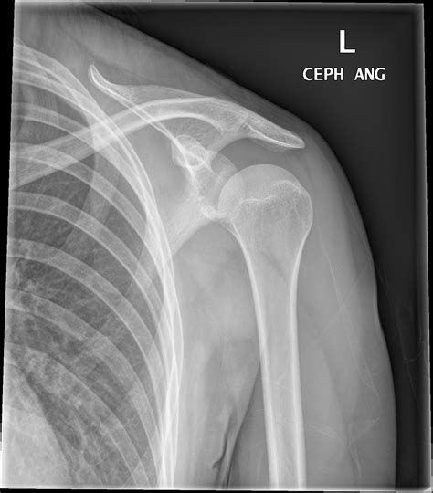 Normal X Ray Shoulder Child at Terry Haskell blog
