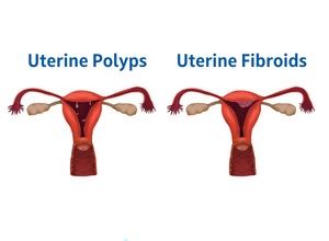 Fibroids vs Polyps: What's The Difference?