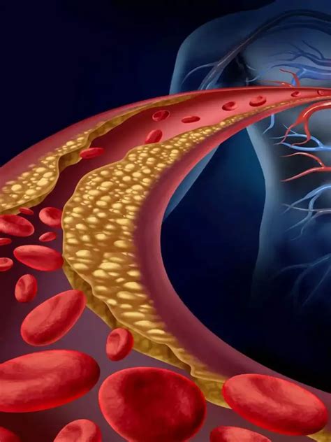 High Cholesterol, High BP Tips: डॉक्टर की सलाह, Cholesterol-High BP की ...