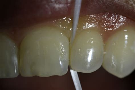 How Do I Best Clean My Teeth? | Smile Philadelphian