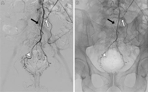 Rectal Artery Embolization for Hemorrhoidal Disease: Anatomy, Evaluation, and Treatment ...