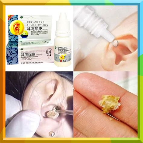 Ear Drops Cleaner | Ear Wax Remover Liquid for Acute and Chronic Otitis, Powerful Softening the ...