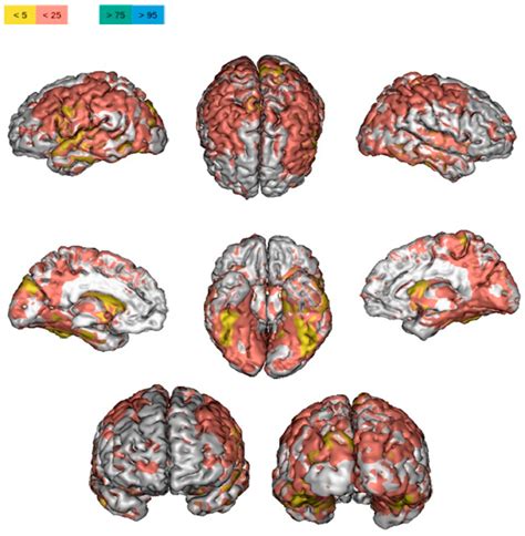 Brain Structural and Functional Alterations in Multiple Sclerosis ...
