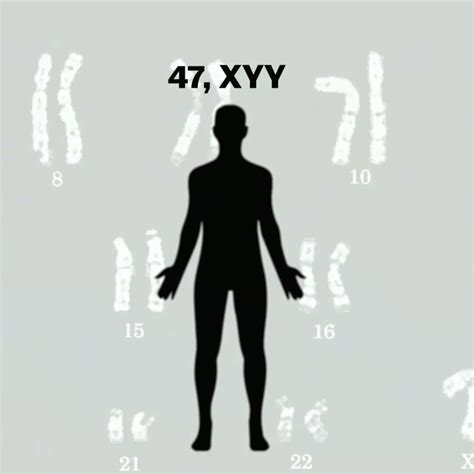 Xyy Super Male Syndrome