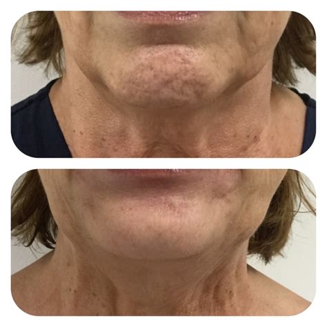 Image result for Chin Botox