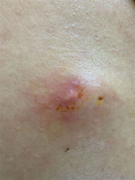 Image result for Removing Carbuncle