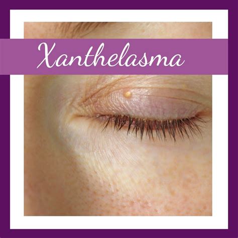 Camouflage Xanthelasma