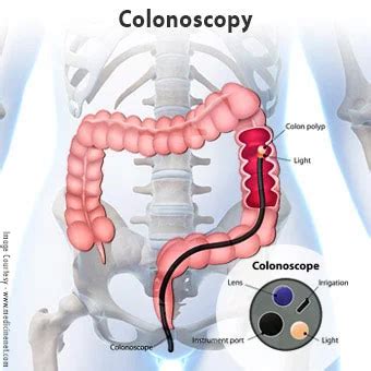 Image result for Why Colonoscopy Test Is Done