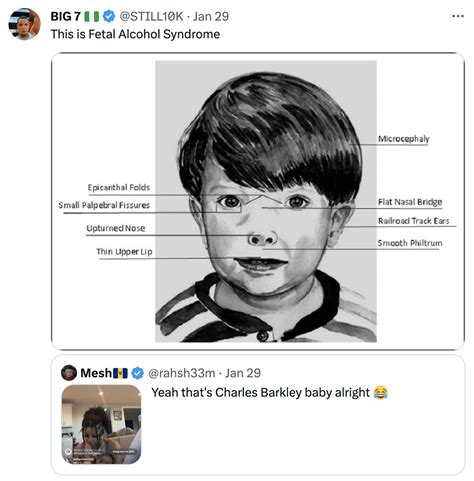 Chrisean Rock's Baby Fetal Alcohol Syndrome post | Blueface and ...