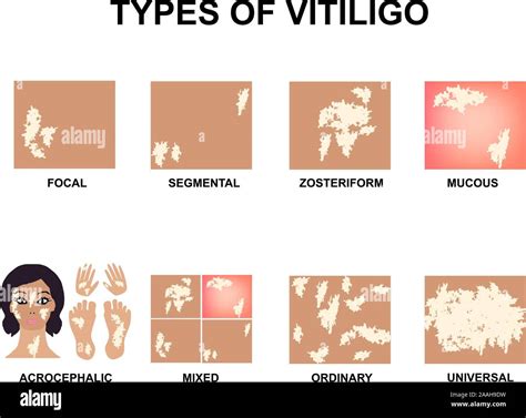 Types of vitiligo. World Vitiligo Day. Infographics. Vector illustration on isolated background ...