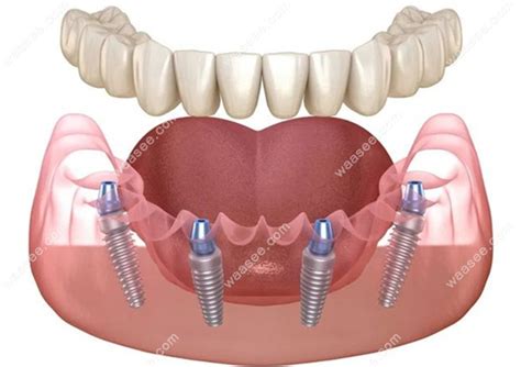 即拔即种即刻负重种植牙与普通常规种植的区别是什么呢？ - 口腔资讯 - 牙齿矫正网