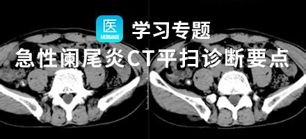 【学术讲座】急性阑尾炎CT诊断的小结_第二人生