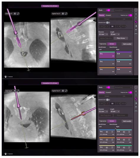 First Clinical Experience with a Novel 3D C-Arm-Based System for ...