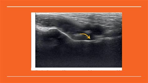 How to Perform Hip Ultrasound 的图像结果