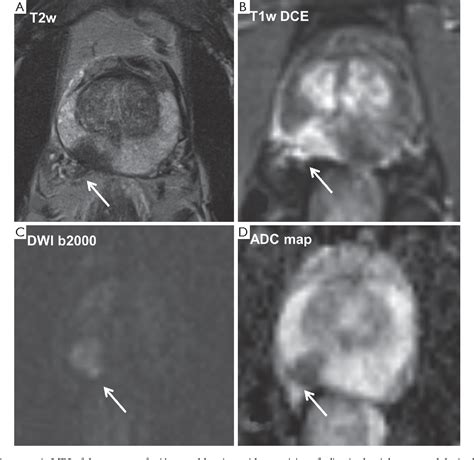 Figure 1 from Diffusion weighted imaging of the prostate—principles, application, and advances ...