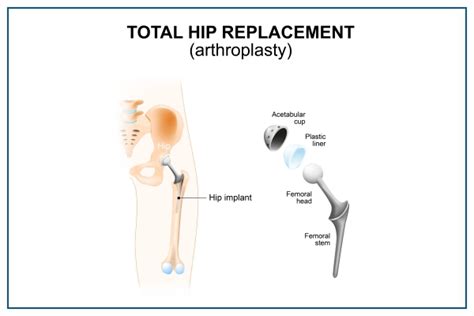 Cirugía de reemplazo de cadera: indicaciones, procedimiento y recuperación