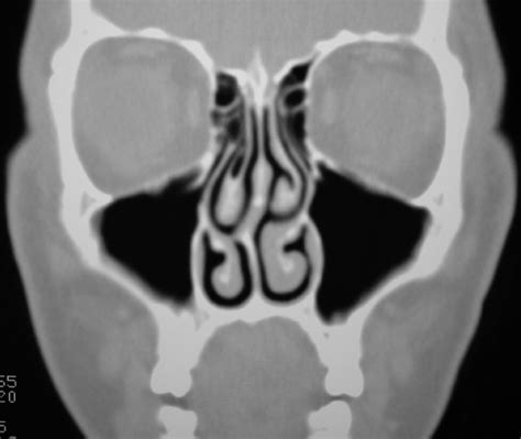 Silent Sinus Syndrome: An Acquired Condition | American Journal of Neuroradiology