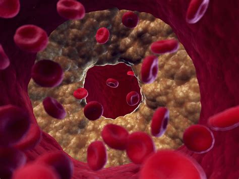 Clogged Arteries: Symptoms, Treatment, and Prevention