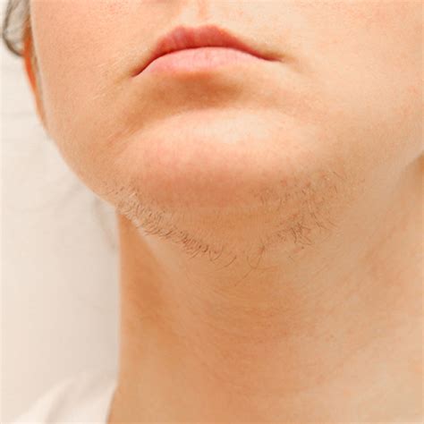 Management of Acne Vulgaris and Hirsutism in Polycystic Ovary Syndrome ...