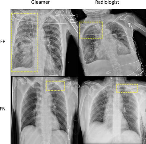 Artificial Pneumothorax 1800S
