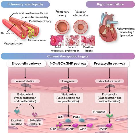 Pulmonary hypertension: recognition, diagnosis and management - The Pharmaceutical Journal