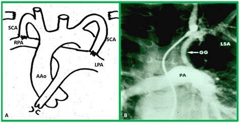 Double-Inlet Left Ventricle