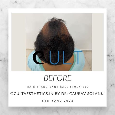 Hair Transplant Case Study 122 | Cult Aesthetics